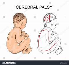 Proving Negligence in a Cerebral Palsy Case: Evidence and Legal Strategies